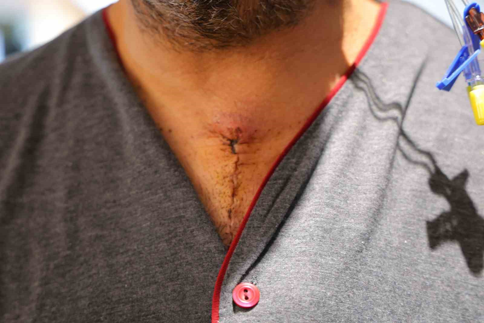 20 dakika beyin dolaşımı durdurulan hasta hayata döndürüldü
