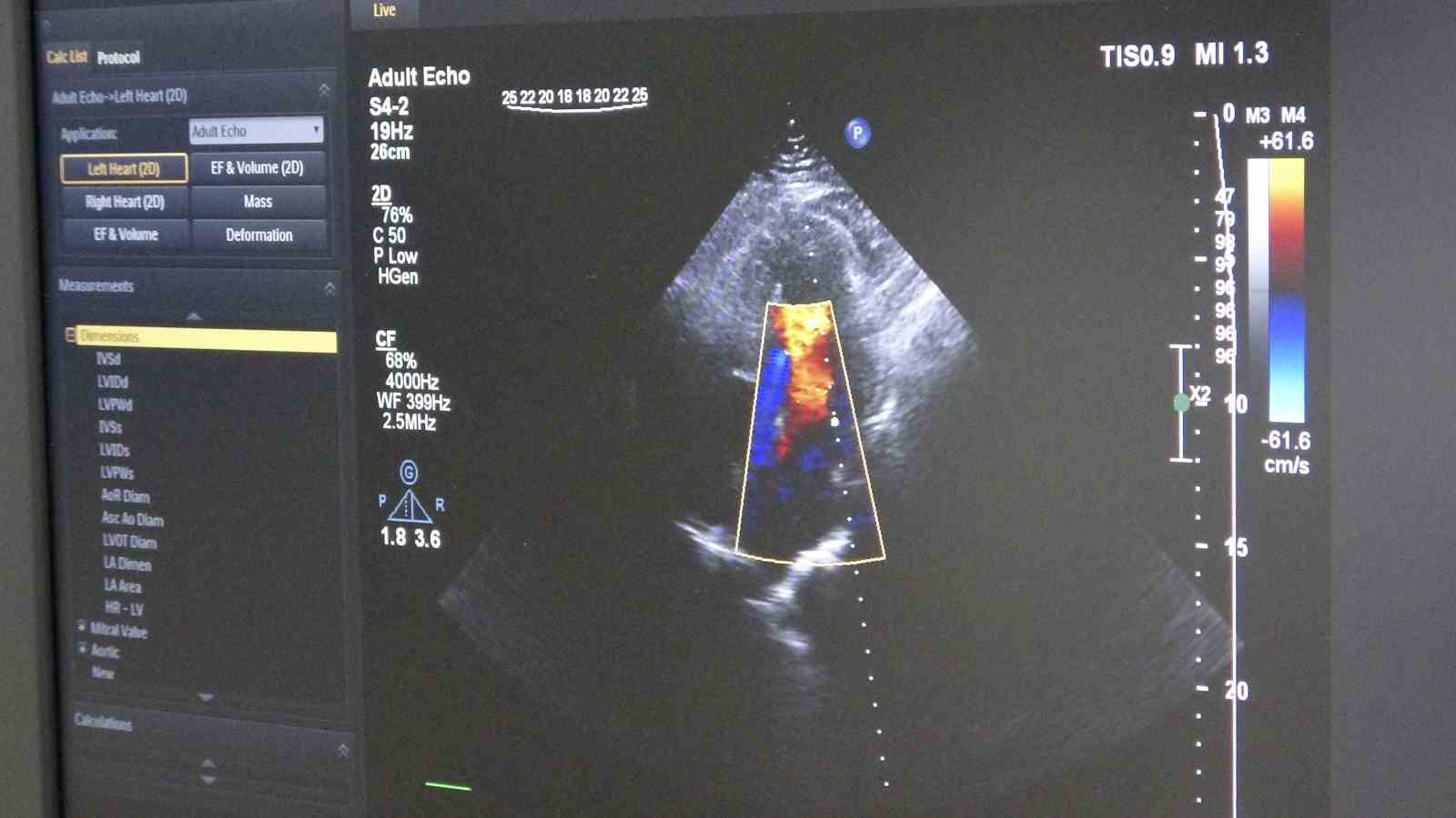 Ameliyatsız, stentsiz tedavi: Kalp damarları ilaç kaplı balonla açıldı
Ameliyatsız, stentsiz tedavi: Kalp damarları ilaç kaplı balonla açıldı