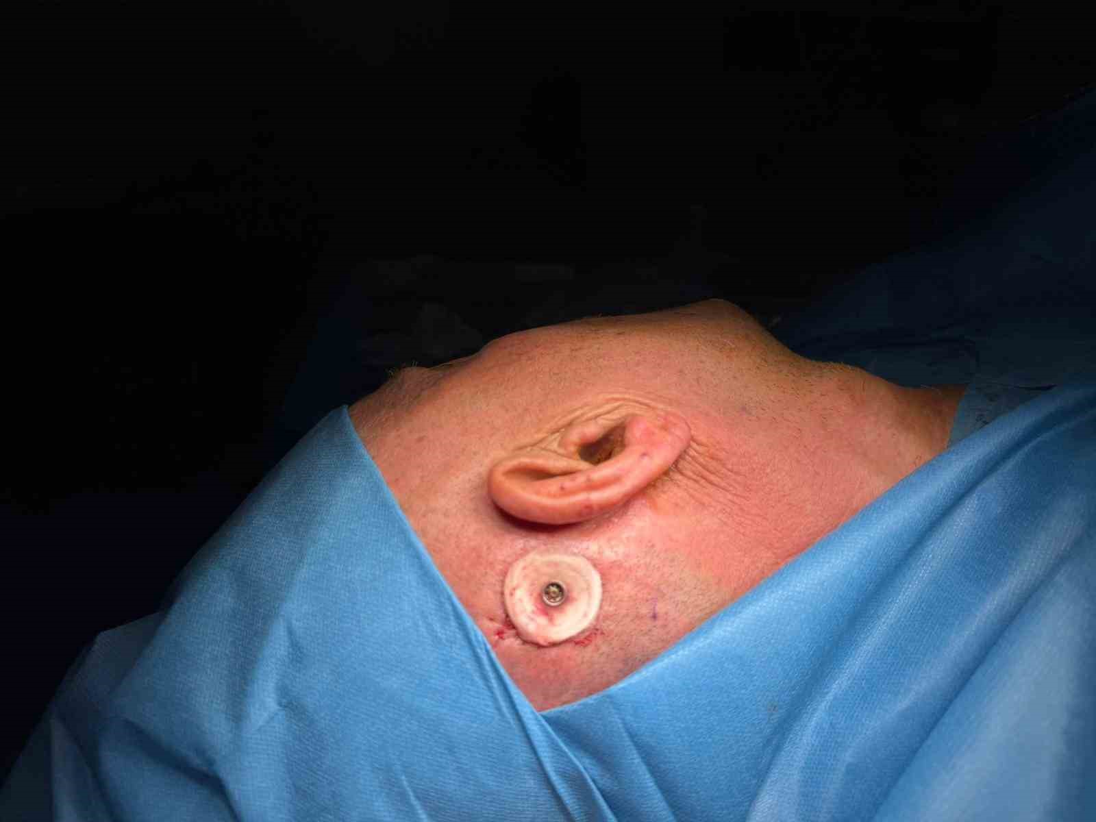 Balıkesir’de ilk kemiğe implante işitme cihazı ameliyatı yapıldı
