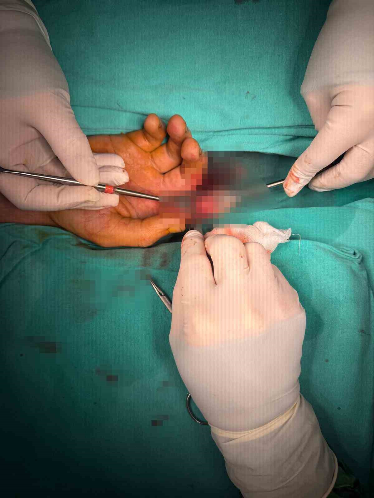 Bandırma’da asansör kazasında kopan parmak başarılı ameliyatla kurtarıldı
