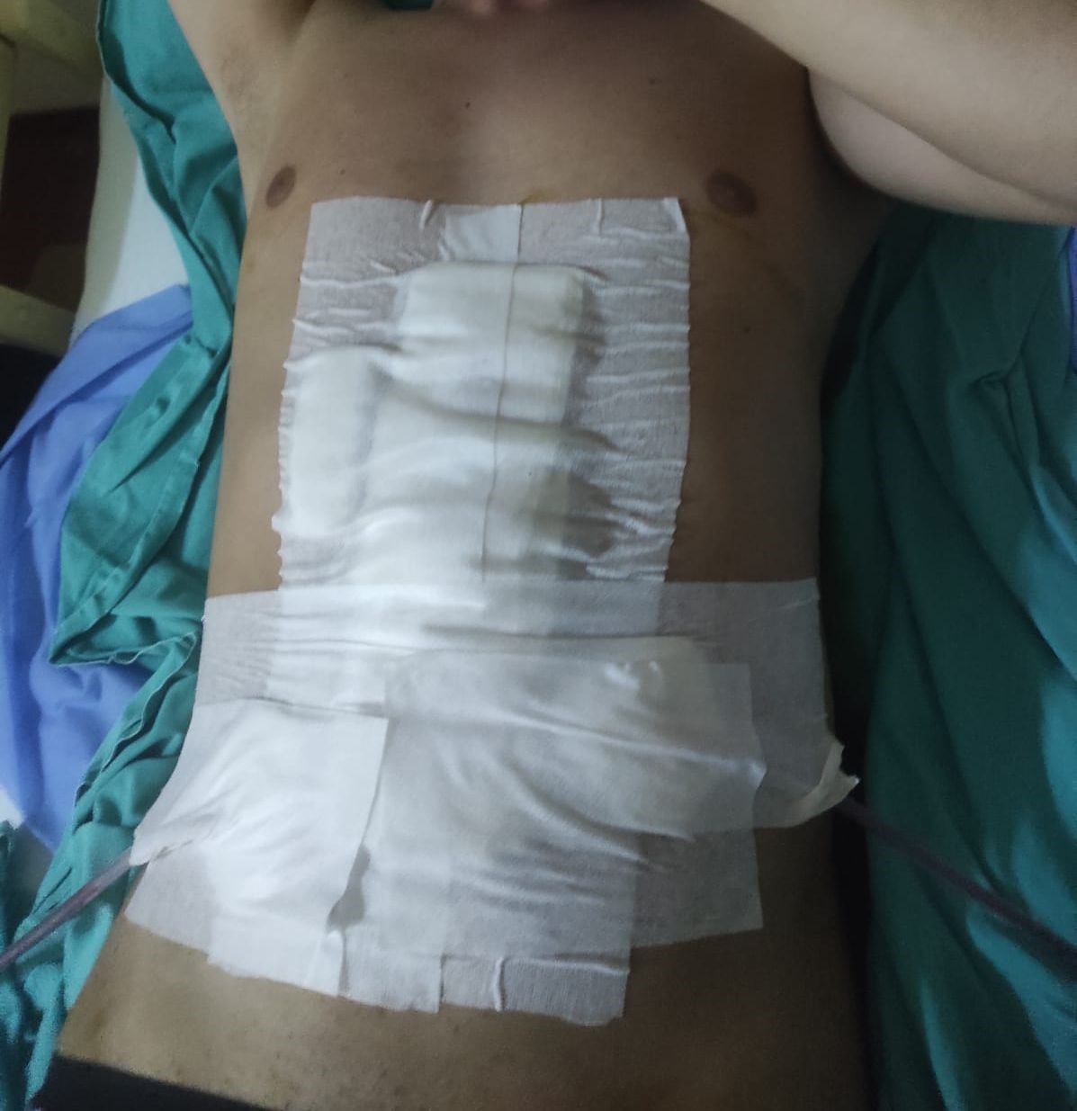 Bandırma’da havalı tüfek kazası: 1 ağır yaralı
