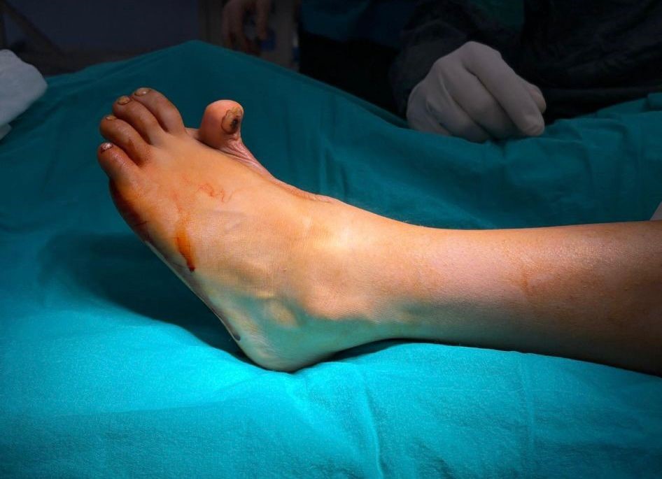 Başparmağında ileri derece hareket kısıtlılığı olan çocuk, operasyonla sağlığına kavuştu
