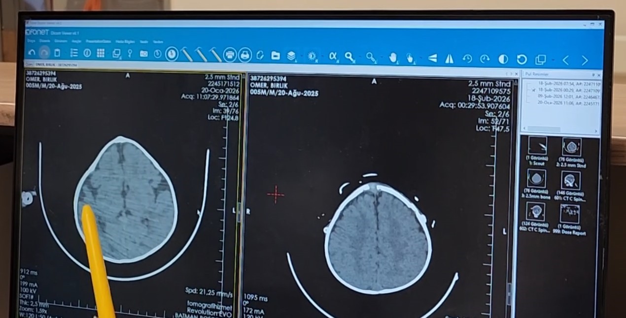 Batman’da kraniyosinostoz teşhisi konulan 5 aylık bebek 3 saatlik ameliyatla sağlığına kavuştu
