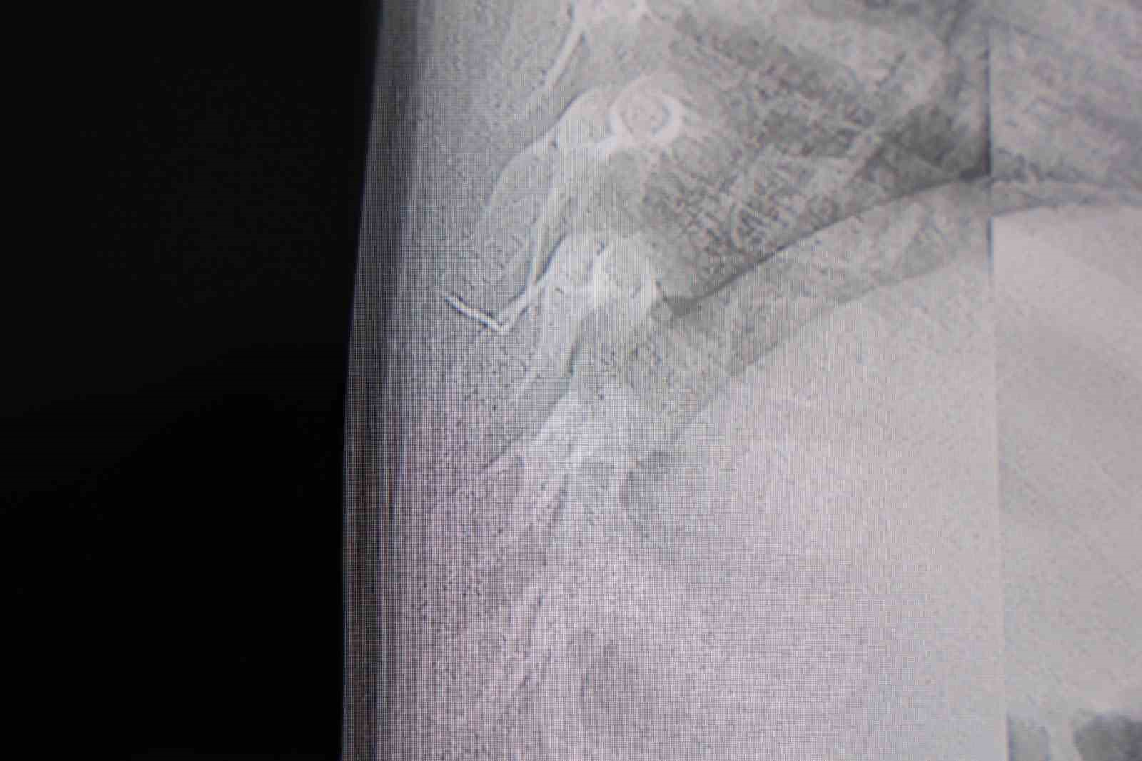 Bebeğin sırtından tel parçası çıktı
