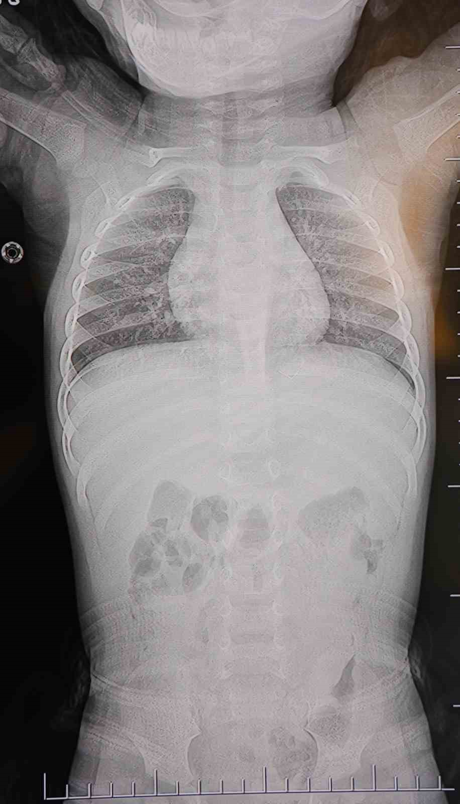 Bebeğin sırtından tel parçası çıktı
