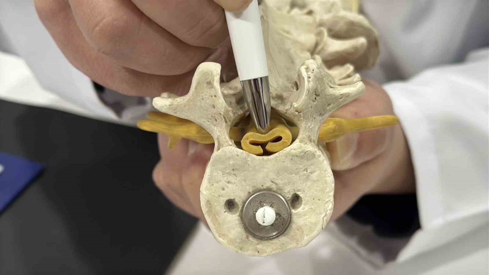 Beldeki gizli tehlike: Spinal stenoz
