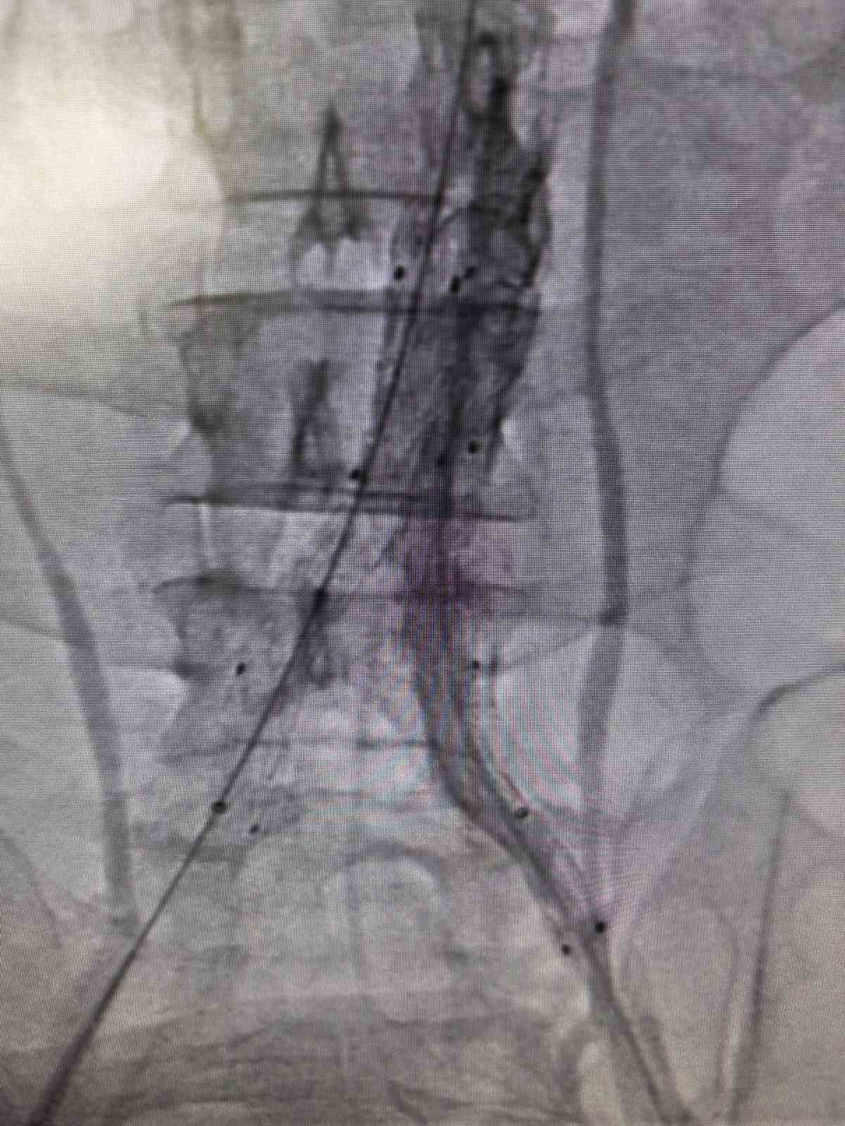 Bilecik’te hayat kurtaran kapalı damar operasyonu
