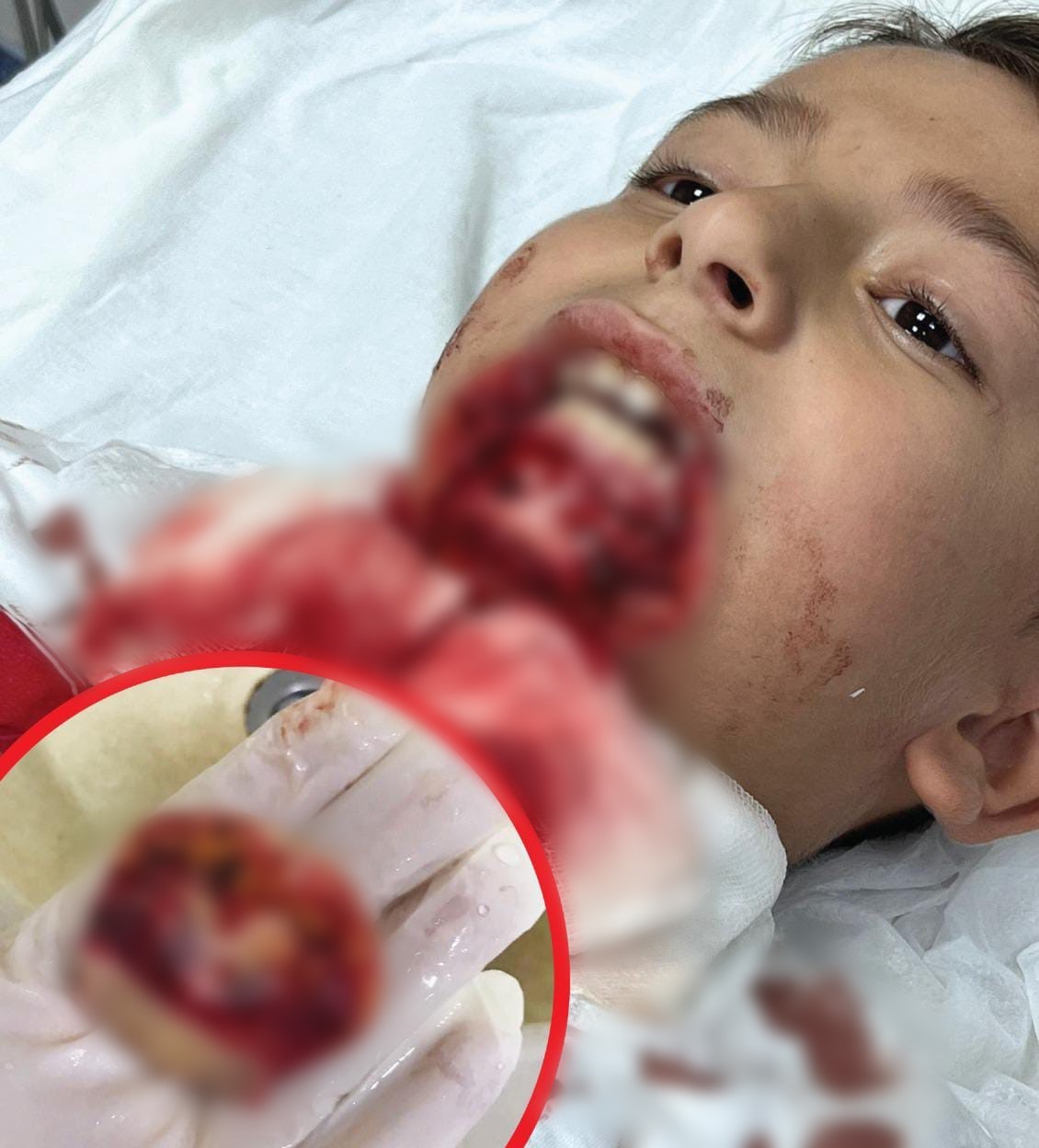 Çanakkale’de çenesine demir saplanan öğrencinin davasının 2’nci duruşması görüldü
