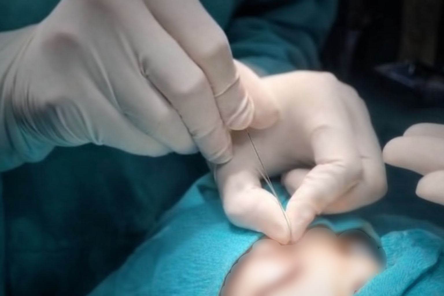 Çukurca’da gözyaşı kanalı ameliyatları yapılmaya başlandı
Çukurca’da gözyaşı kanalı ameliyatları yapılmaya başlandı