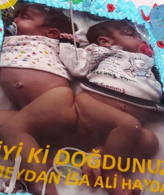 Depremle birlikte öksüz ve yetim kalan siyam ikizi kardeşleri 9 yaşında ölüm ayırdı
