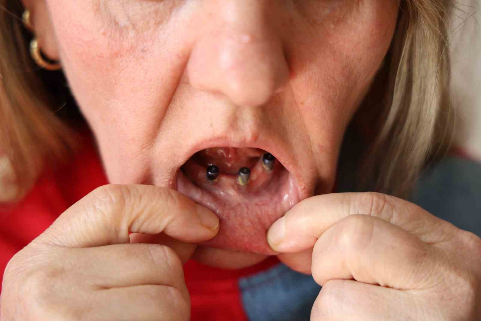 Diş ağrısı şikayetiyle gitti 25 dişinden oldu
