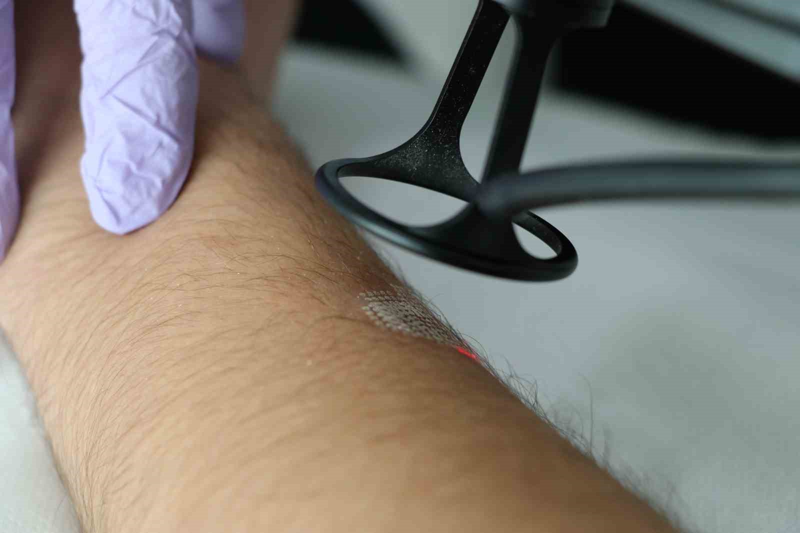 Doğru mevsim seçimi lazer tedavilerinde başarıyı artırıyor
