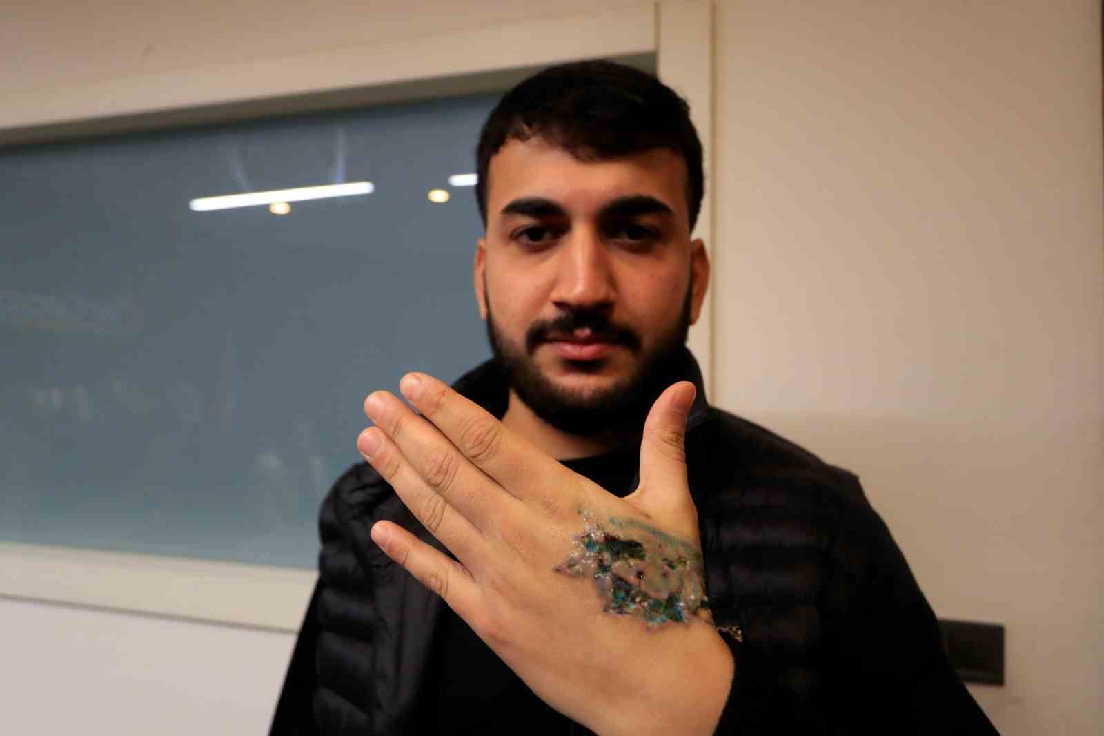 Dövme sildirmek isterken kabusu yaşadı, elindeki dokular öldü
