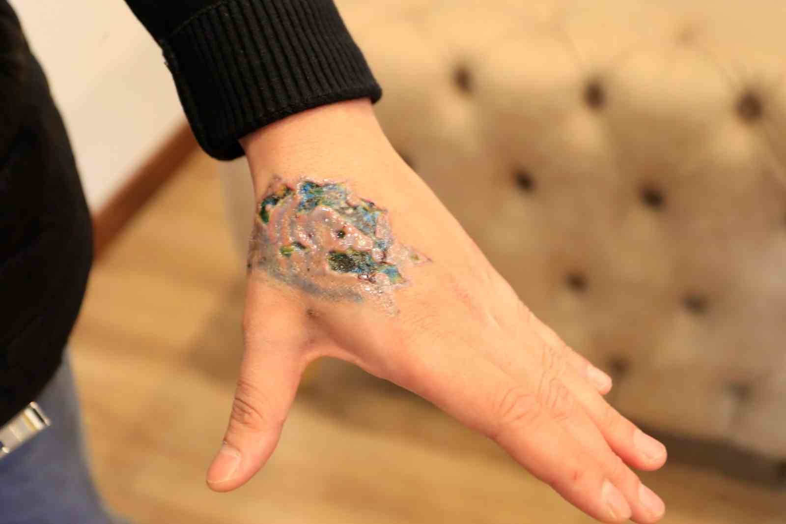 Dövme sildirmek isterken kabusu yaşadı, elindeki dokular öldü
