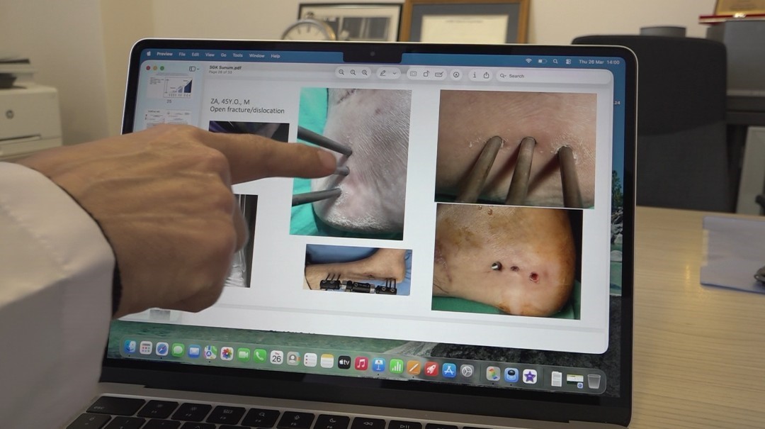 Dünyanın ilk enfeksiyonlu bölgeye uygulanabilen yapay kemiği Eskişehir’de geliştirildi
