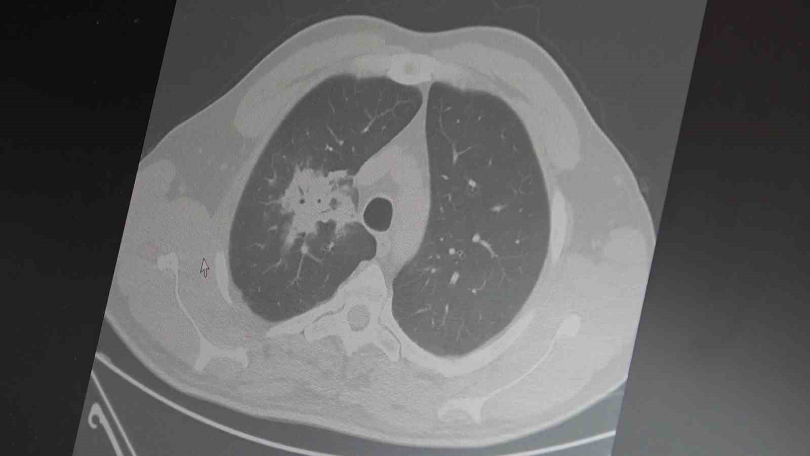 Elektronik sigarada süre doldu: "Kanser riski netleşti"
