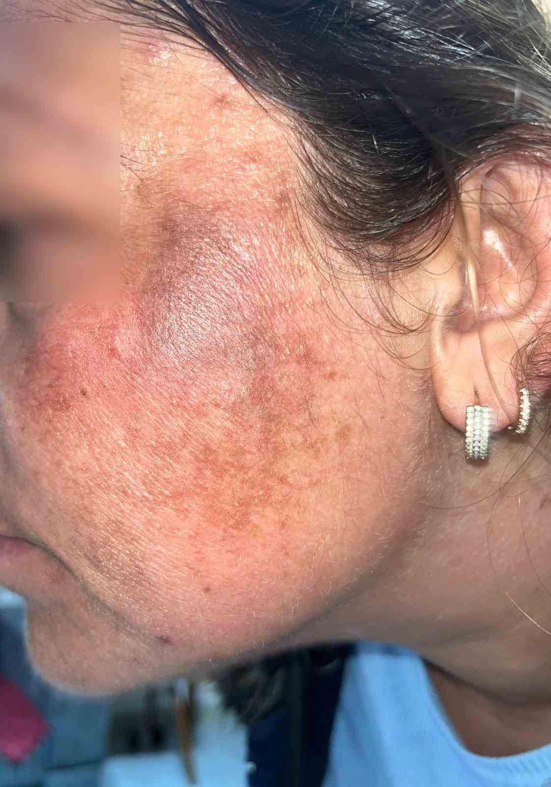 Güzelleşmek uğruna gittiği merkezde yüzü yandı
