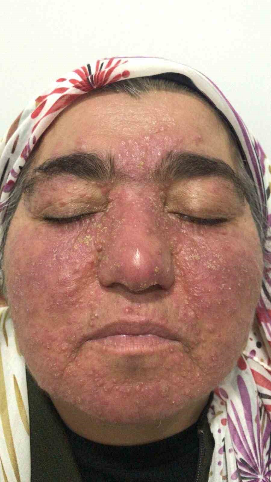 Hastalığı yüzünden yıllarca evden çıkamadı, şimdi ise çekinmeden çıkabiliyor
