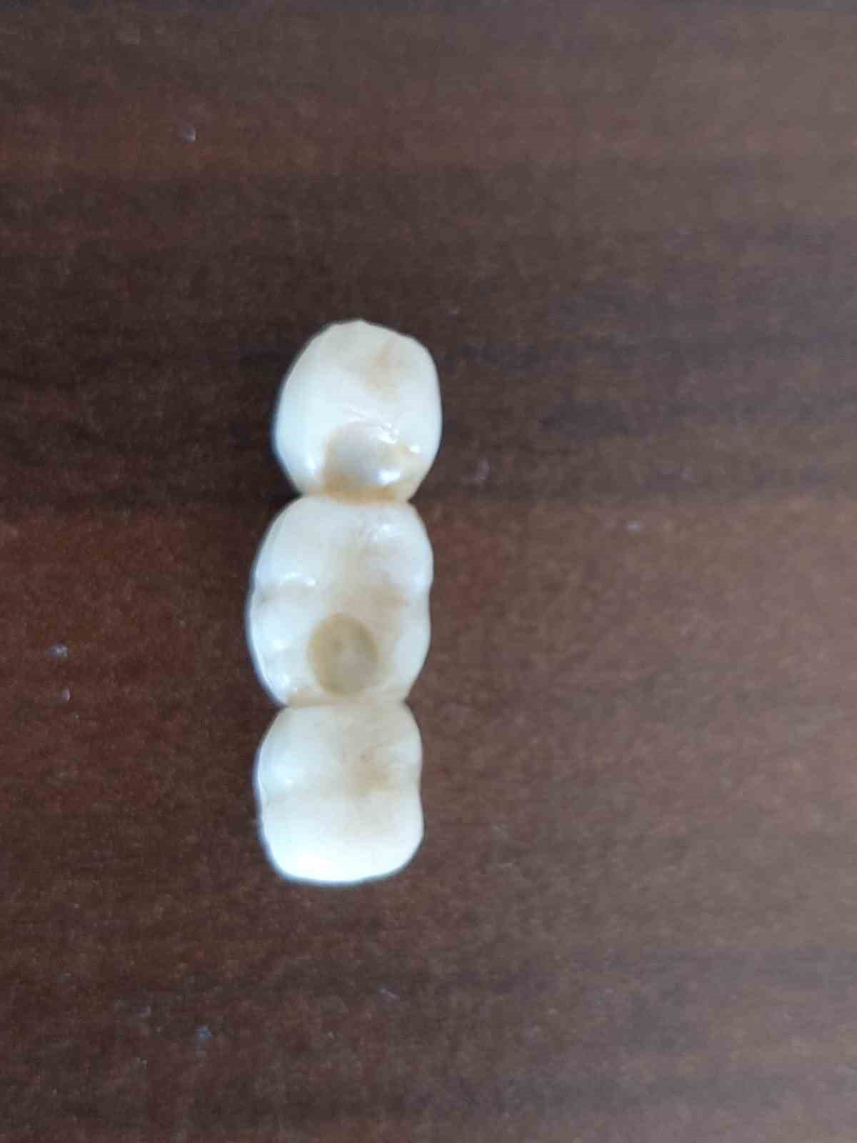 İmplant elinde hasta şikayette
