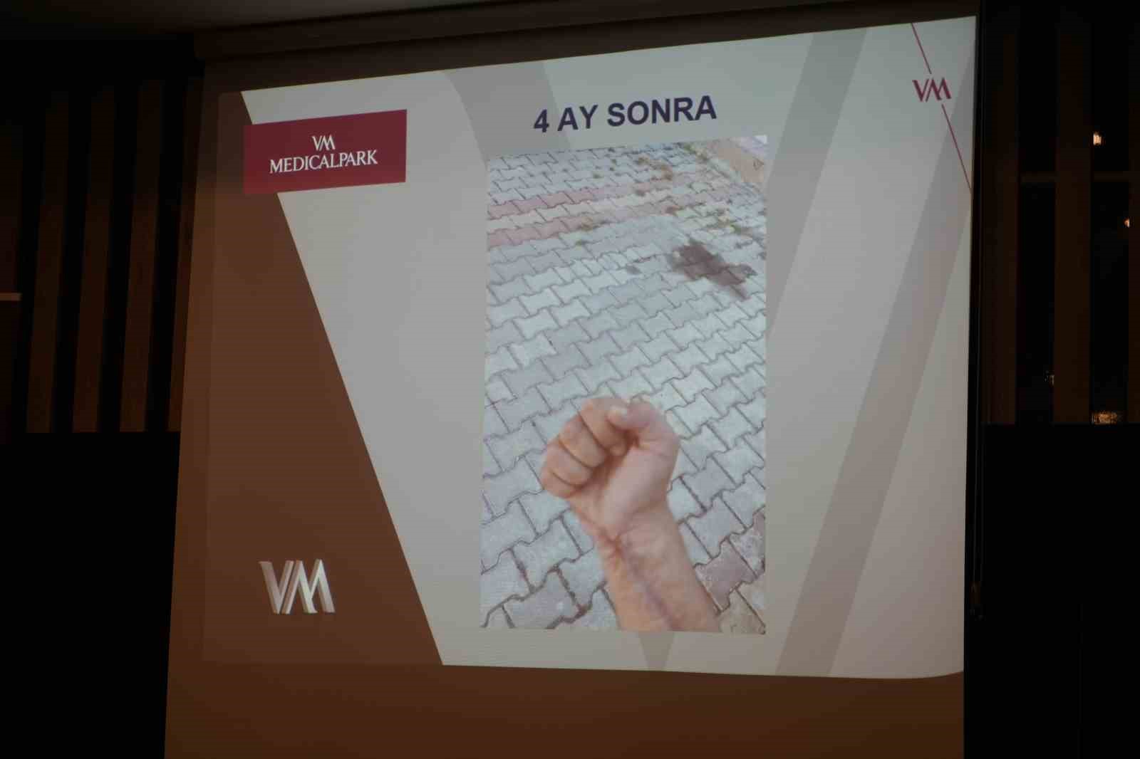 İş kazalarında erken müdahale uzvun durumunu belirliyor
