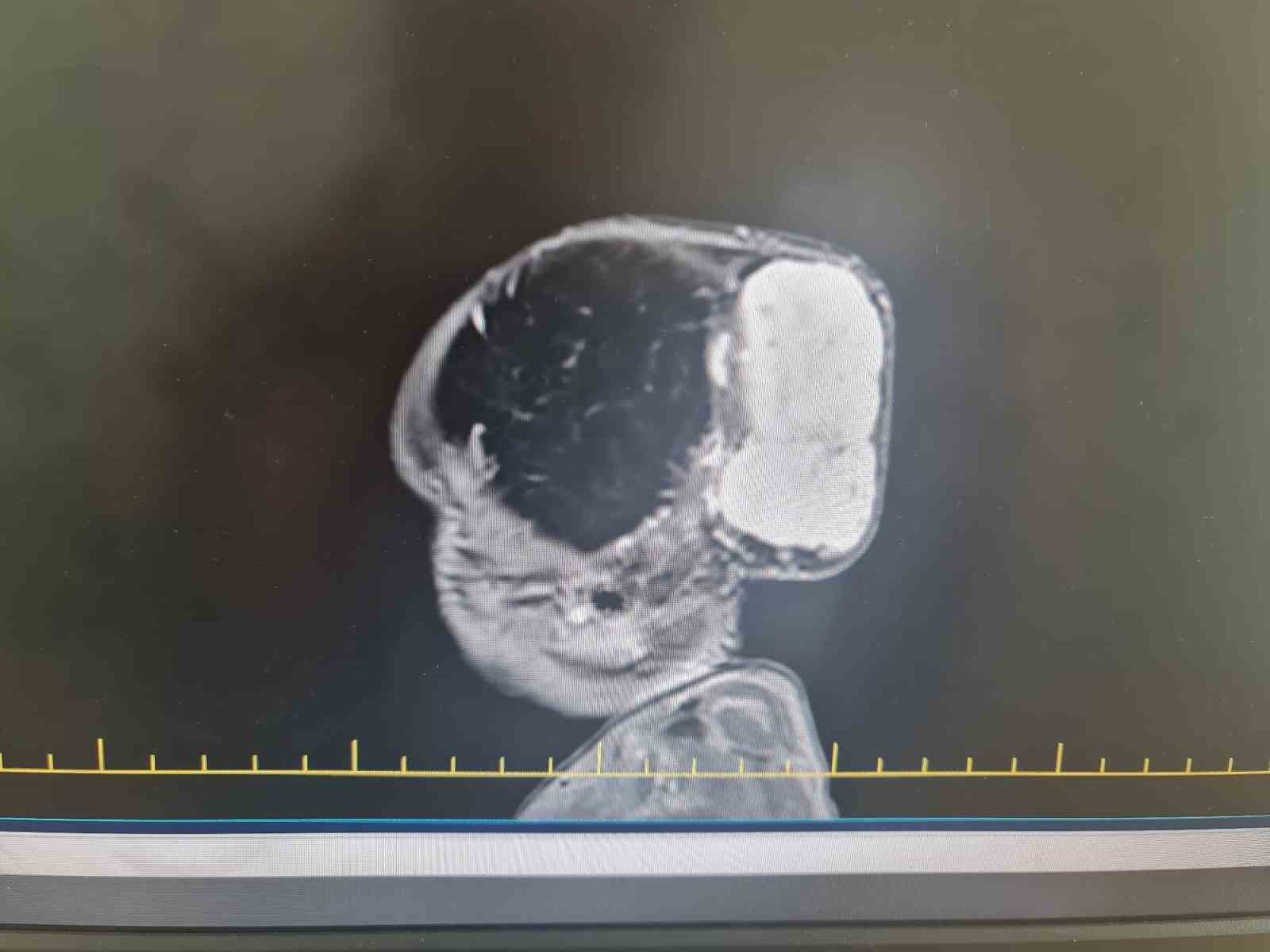 Kafasındaki nadir tümör alındı, hayata tekrar gülümsedi
Kafasındaki nadir tümör alındı, hayata tekrar gülümsedi