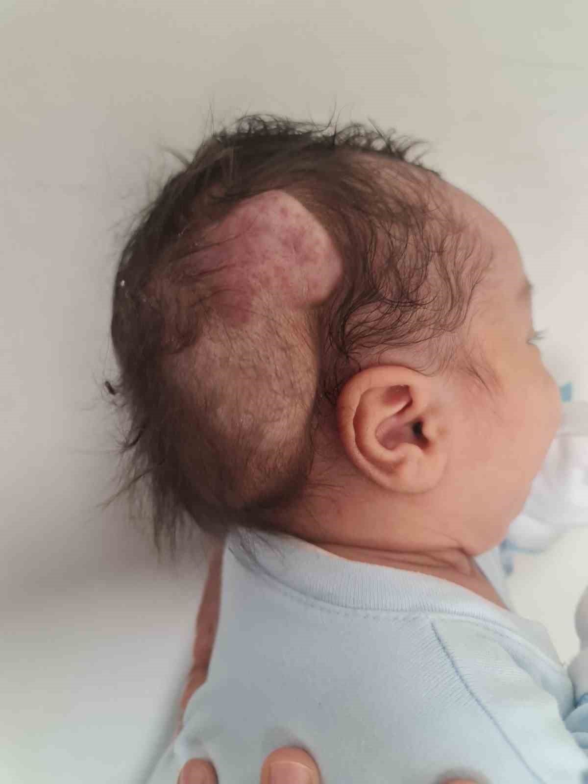 Kafasındaki nadir tümör alındı, hayata tekrar gülümsedi
Kafasındaki nadir tümör alındı, hayata tekrar gülümsedi