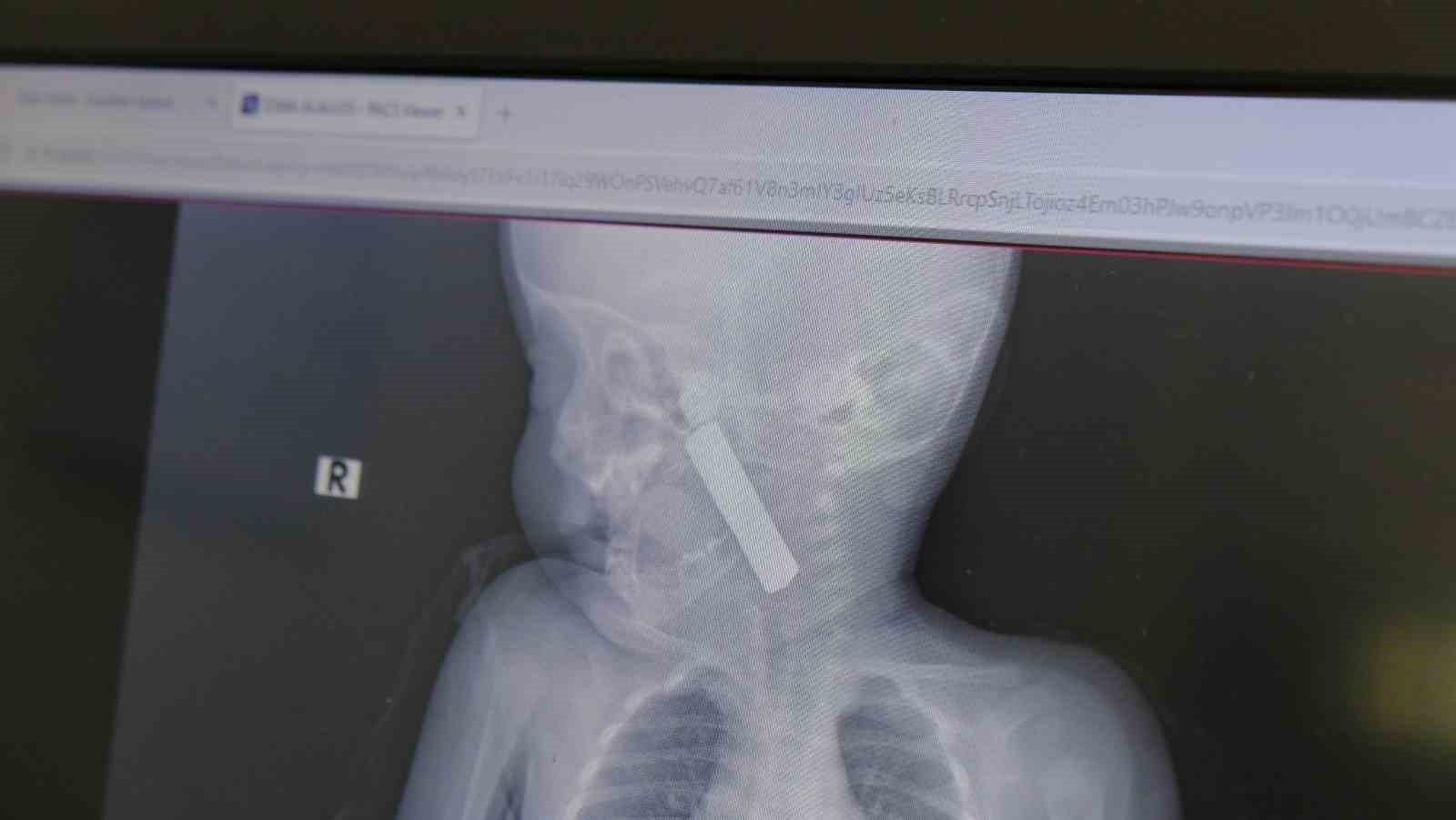 Karaman’da boğazına kumanda pili kalan kaçan bebek ölümden döndü
Karaman’da boğazına kumanda pili kalan kaçan bebek ölümden döndü