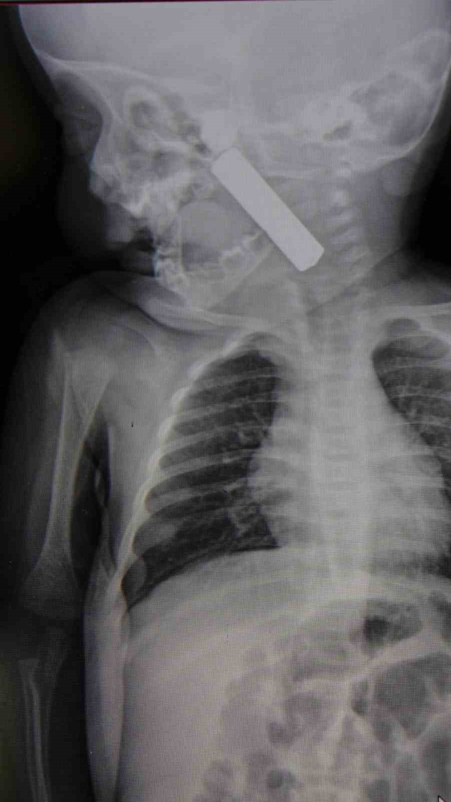 Karaman’da boğazına kumanda pili kalan kaçan bebek ölümden döndü
Karaman’da boğazına kumanda pili kalan kaçan bebek ölümden döndü