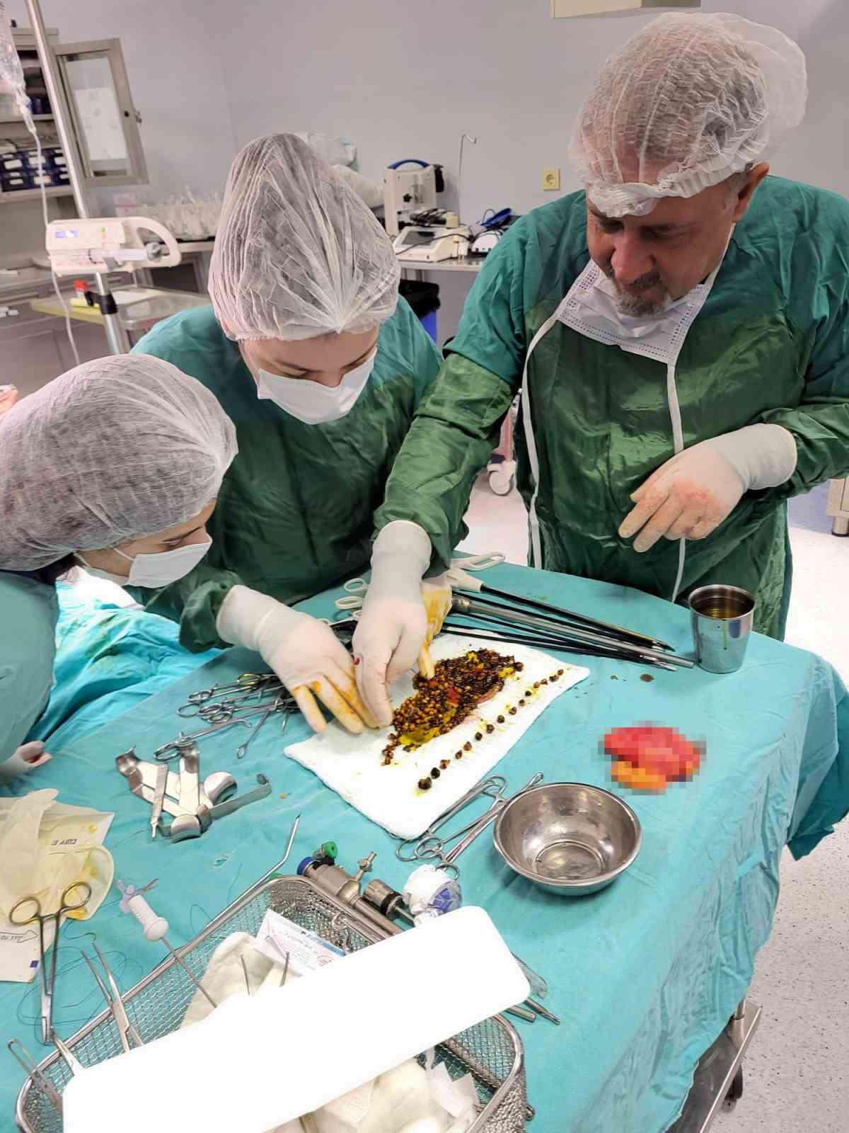 Karın ağrısıyla gitti, safrasından binlerce taş çıktı
