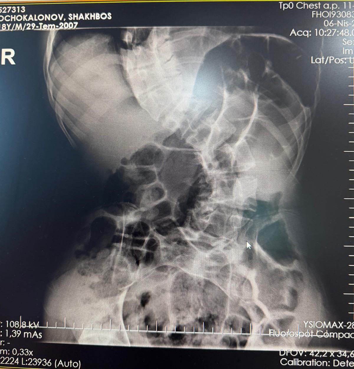 Kırgızistanlı genç şifayı Türk hekimlerinde buldu
