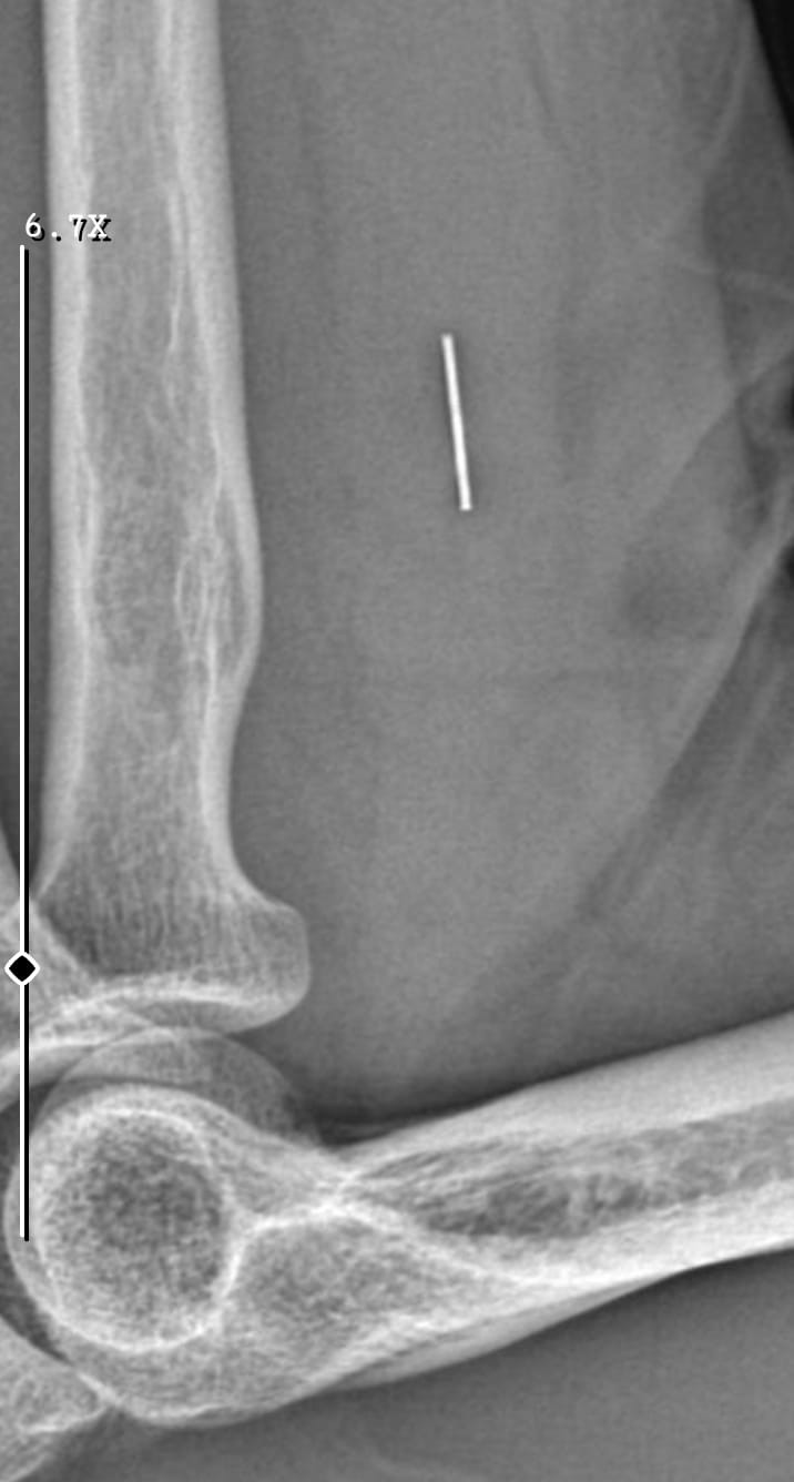 Kurban Bayramı’nda parmağını kesti, başına gelmeyen kalmadı
