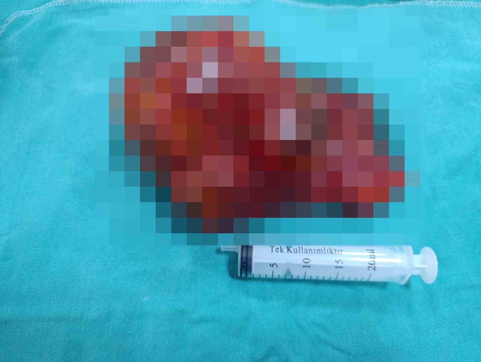 Malatya’da 20 santimetrelik kitle kapalı yöntemle çıkarıldı
