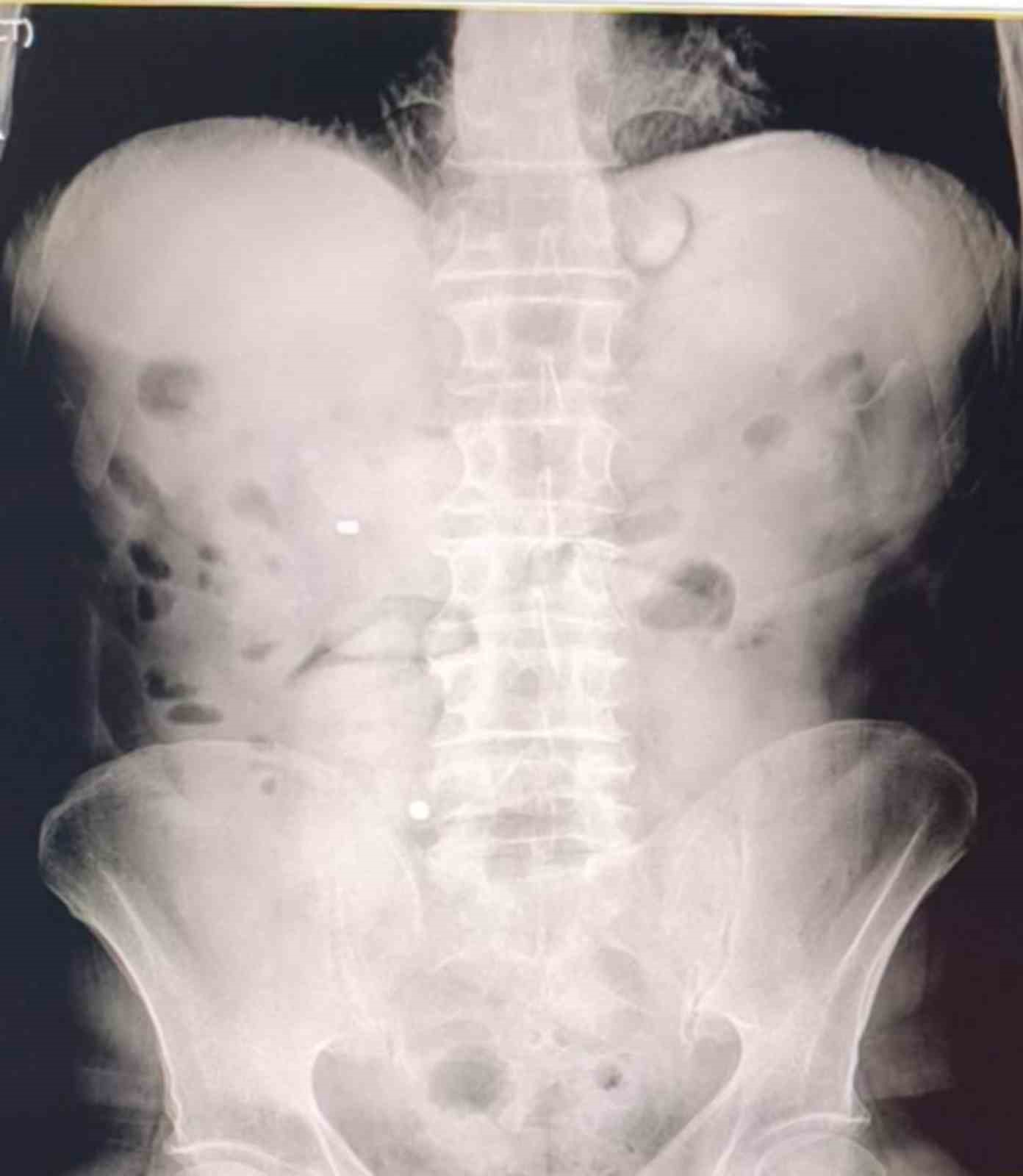 Midelerinden 1 kilo 70 gram metamfetamin çıktı
