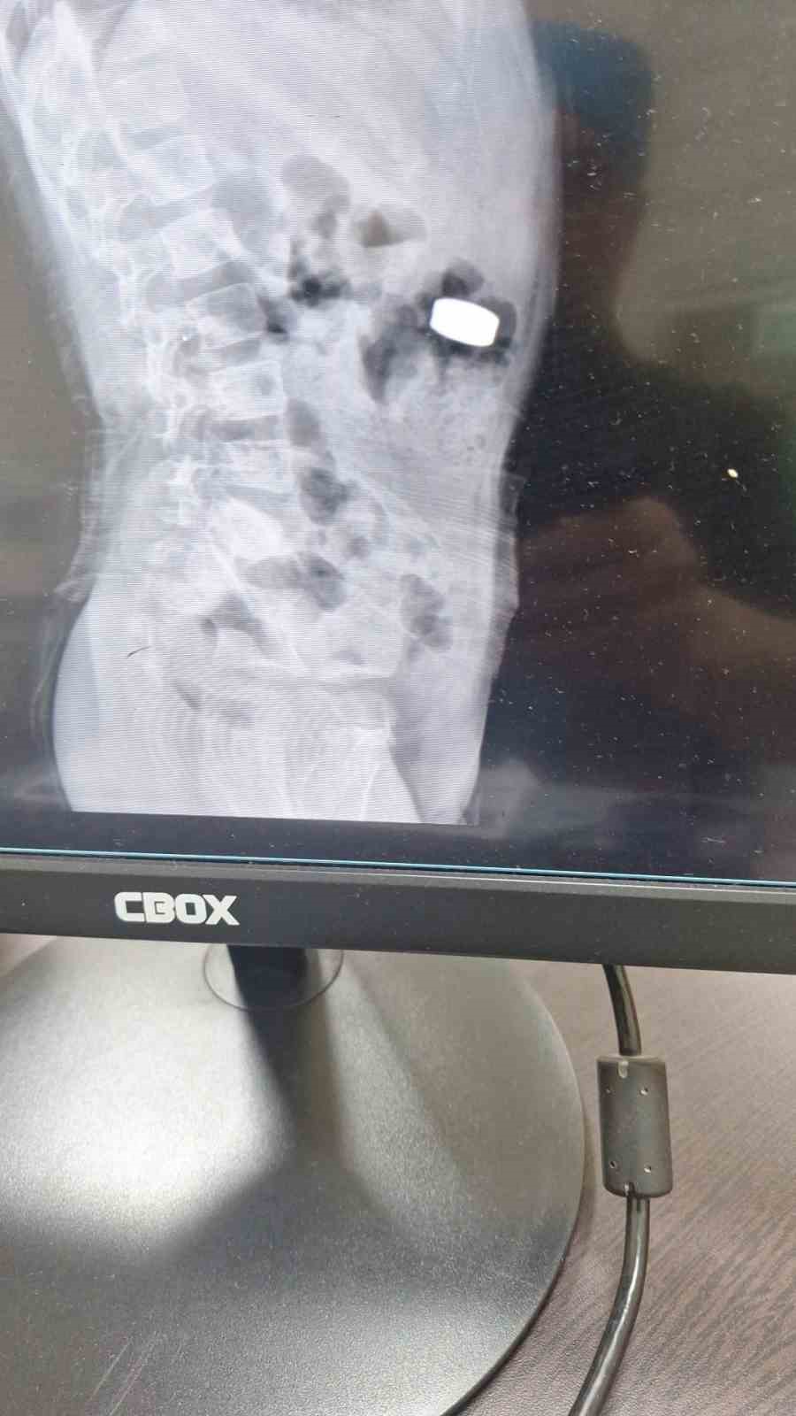 Mıknatıs yutan çocuk, ameliyatla sağlığına kavuştu
