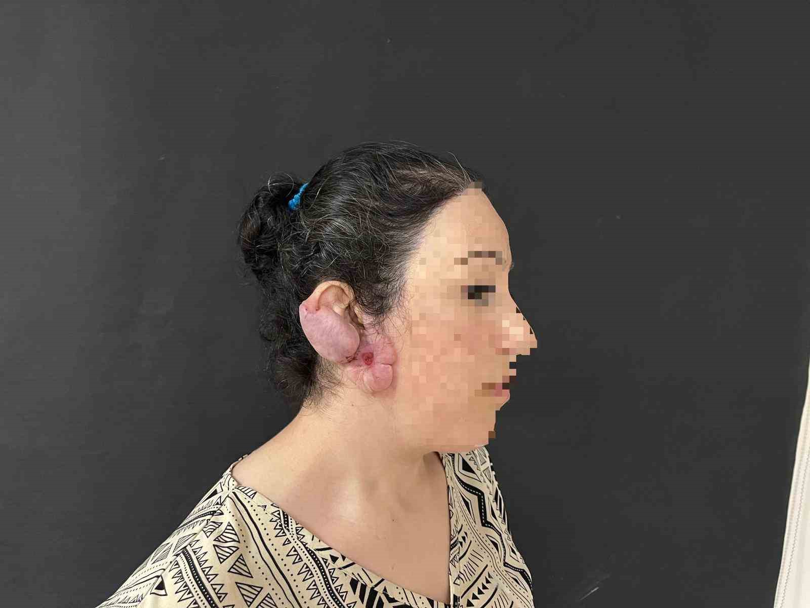 Muş’ta bir ilk: Kulak keloidi, ödüllü cerrahi teknikle tedavi edildi
