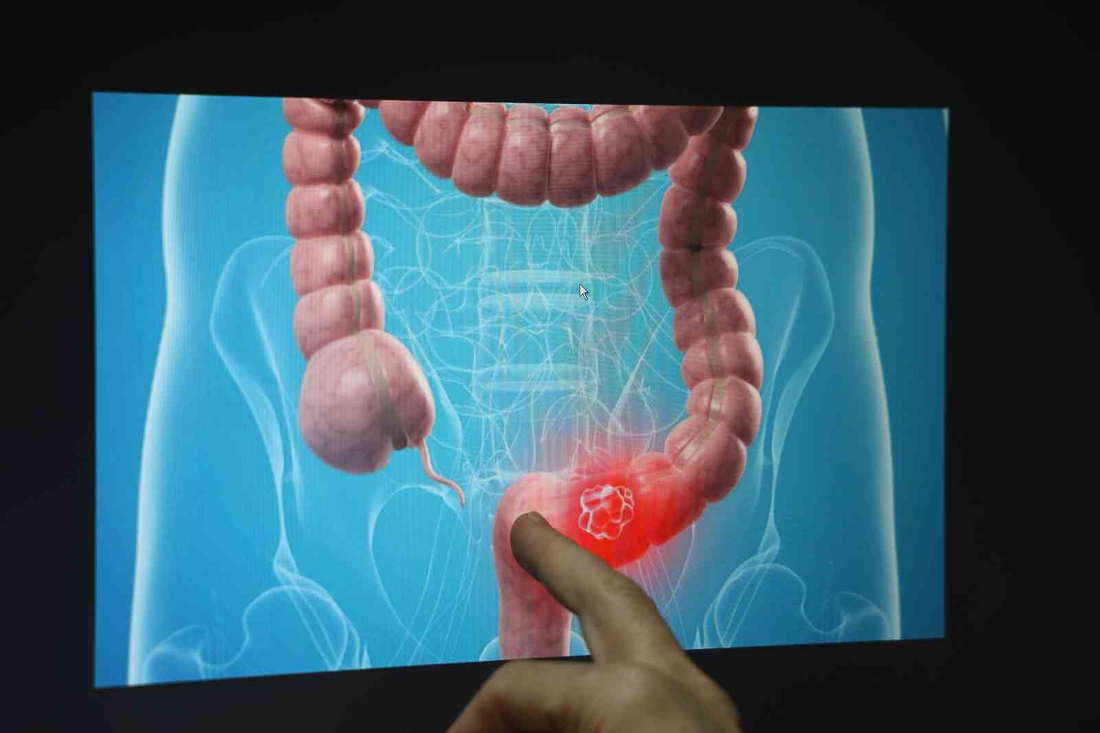 Op. Dr. Baysal: "Özellikle gençlerde son 5 yılda rektum kanseri 4 kat, kalın bağırsak kanseri 2 kat daha fazla görülmeye başlanmıştır"
