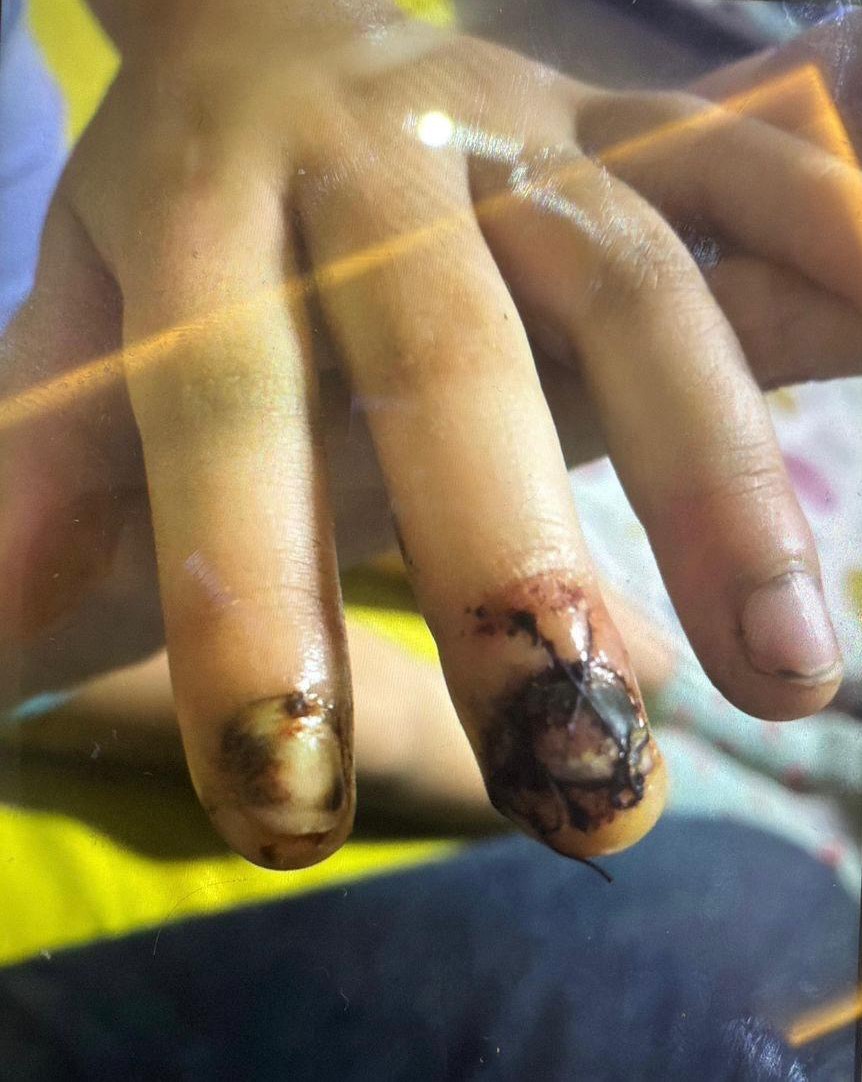 Özel okulda skandal görüntü kameraya yansıdı: Çocuğun parmakları bu hale geldi
