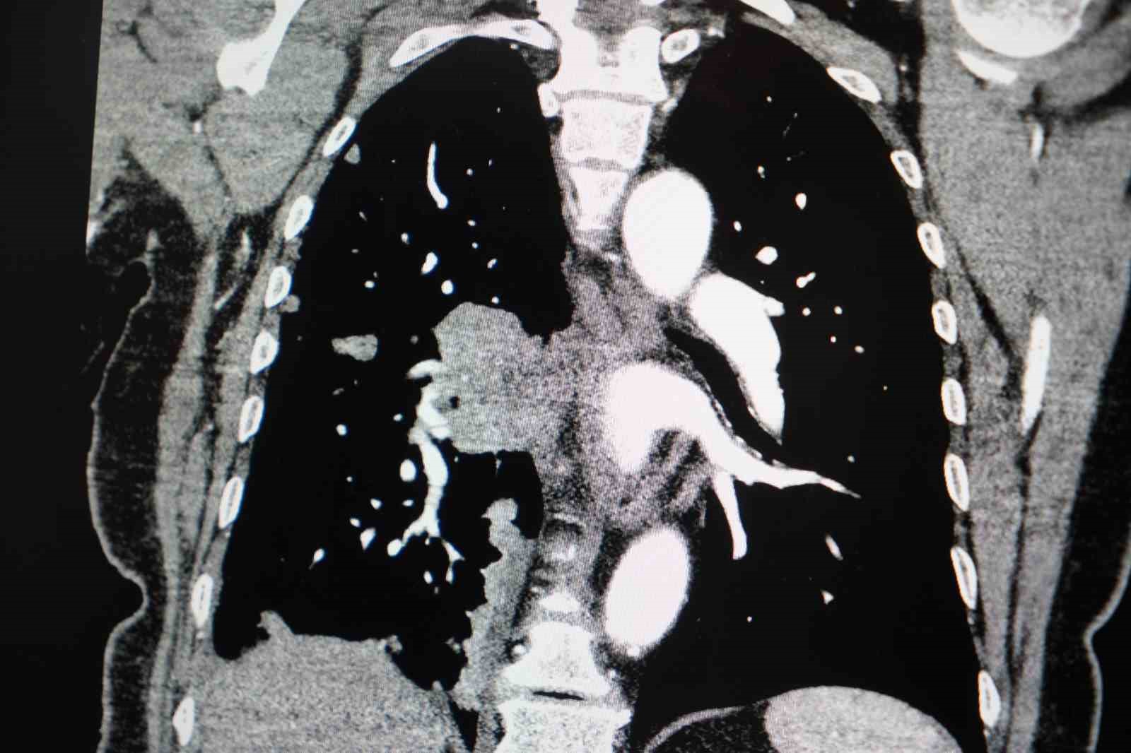Profesörden korkutan sigara açıklaması: "Kadınlarda sigara kullanımı son 10 yılda yüzde 38 arttı"
