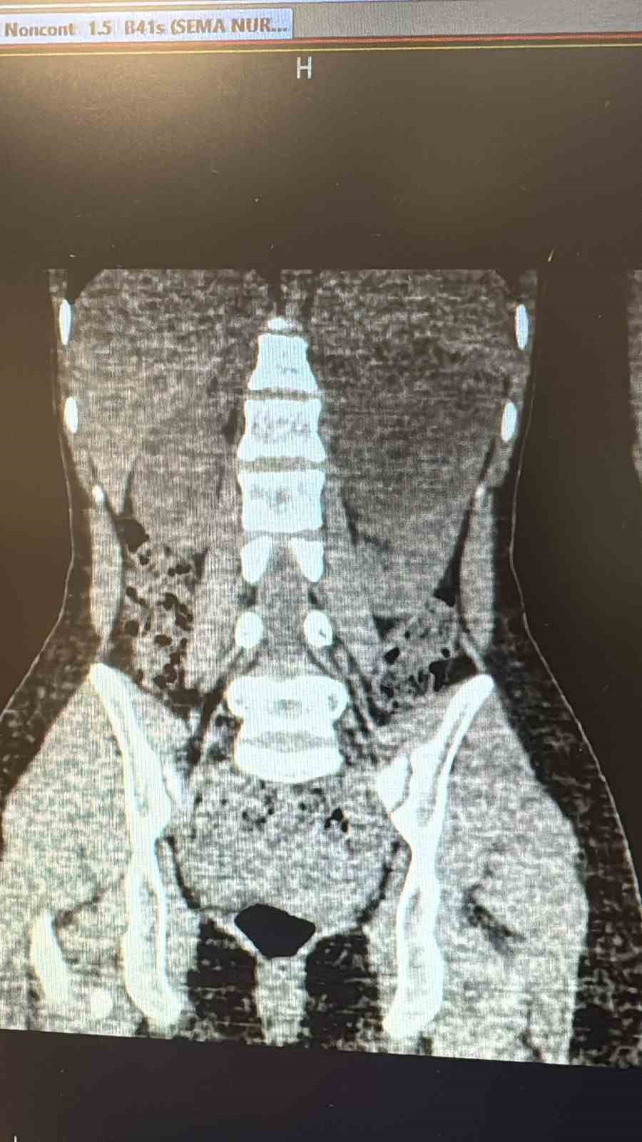 Şanlıurfa’da 10 santimetrelik böbrek kisti kapalı yöntemle alındı
