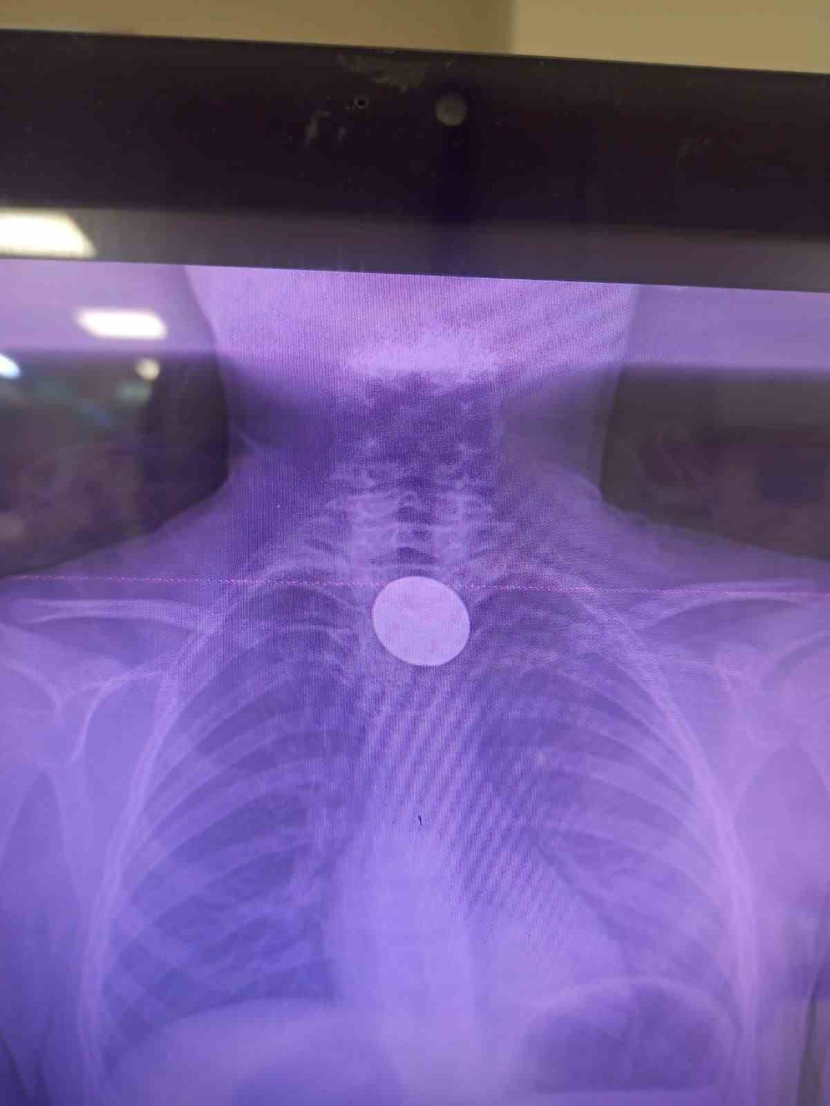 Siirt’te boğazına madeni para kaçan çocuk, doktorların müdahalesi ile kurtarıldı
