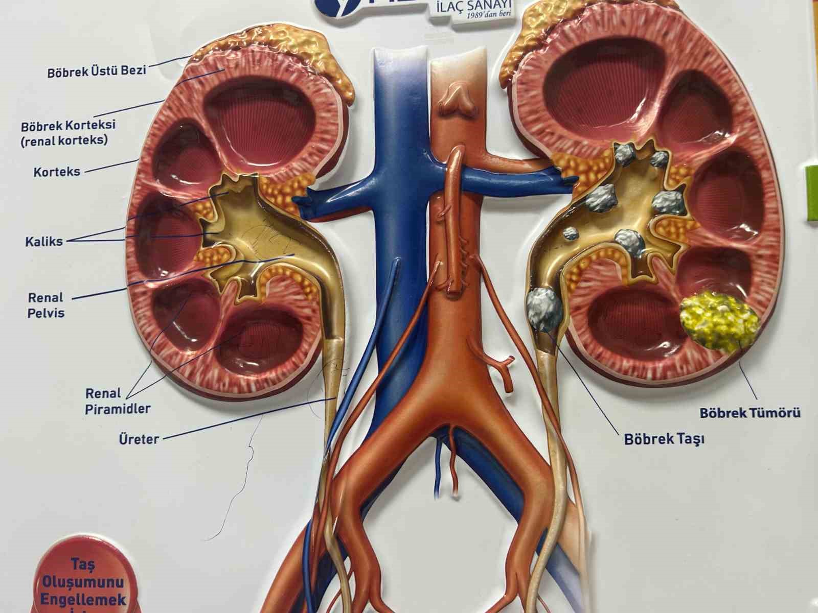 Üroloji Uzmanı Dr. Şığva: "Taş hastalığı böbrek kaybına yol açıyor"
