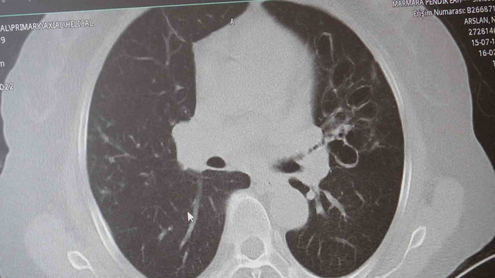 Uzmanından dünyada en çok öldüren 4’üncü hastalık için uyarı: "KOAH’ı sigarayı bırakmak, zatürreyi aşı durdurur"
