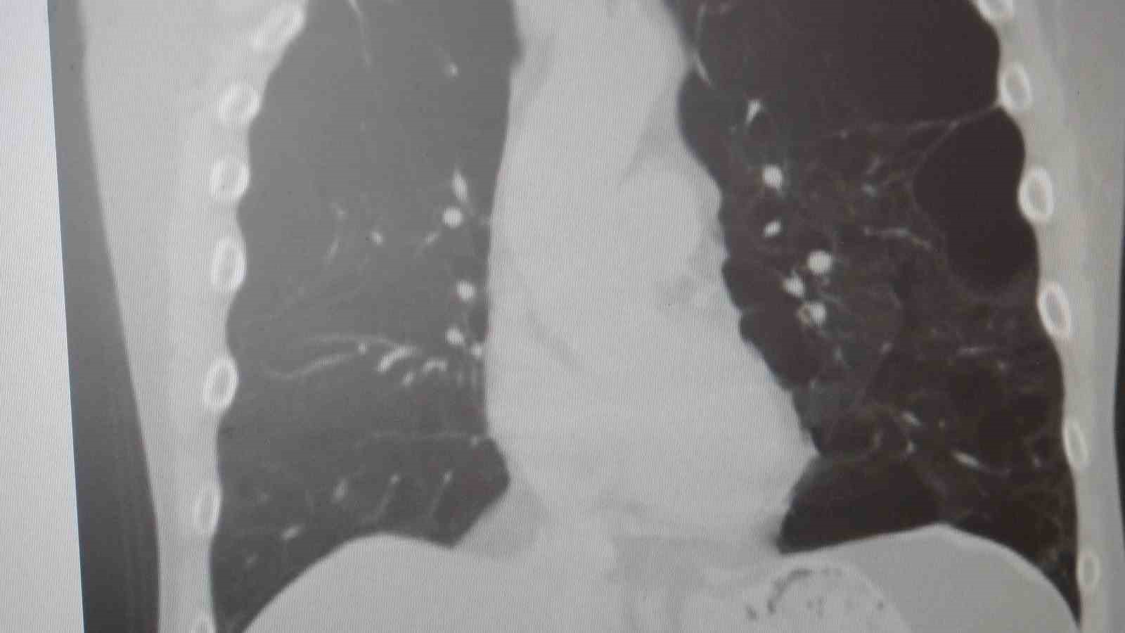 Uzmanından dünyada en çok öldüren 4’üncü hastalık için uyarı: "KOAH’ı sigarayı bırakmak, zatürreyi aşı durdurur"
