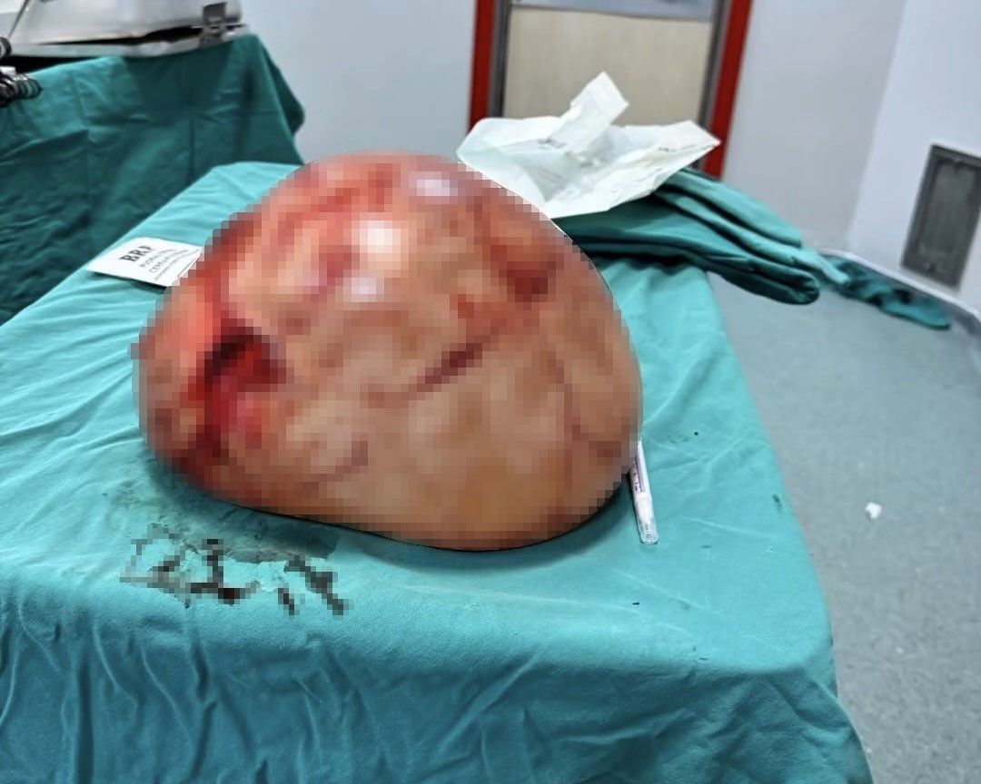 Van’da bir kadının karnından 35 santimetrelik dev kitle çıkarıldı
