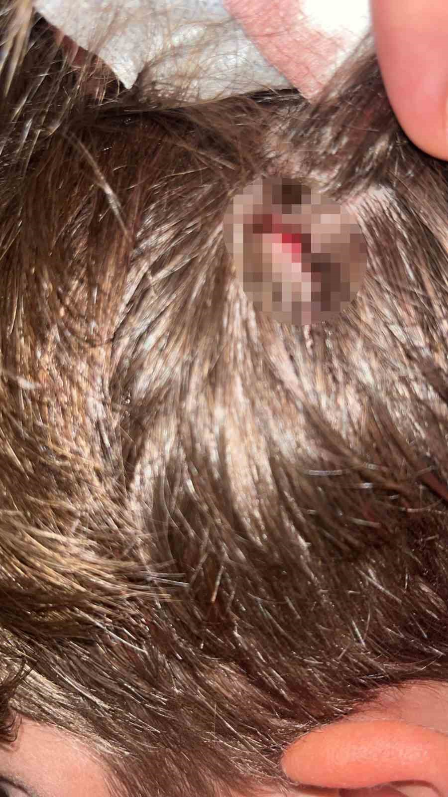 Yalova’daki komşu kavgasında bu kez 8 yaşındaki çocuğa taşlı saldırı
