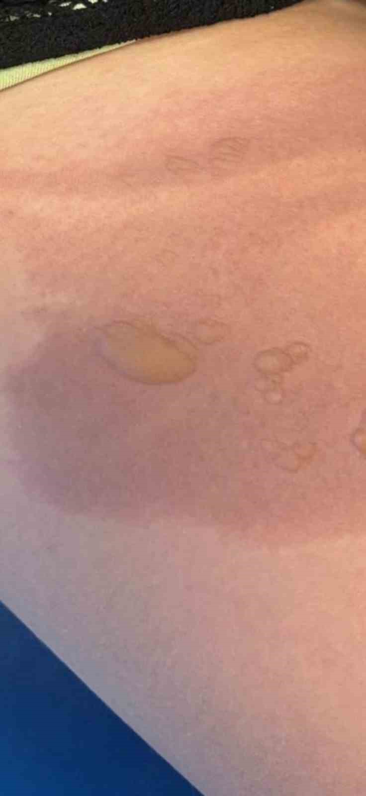 Yine sıcak su torbası yine facia: "Koyduktan 3 dakika sonra patladı"
