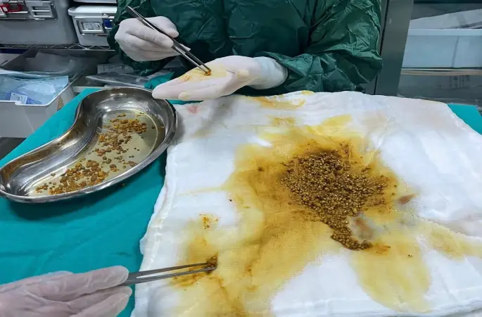 Bingöl’de nadir vaka: Safra kesesinden 2 bin 67 taş çıkarıldı
