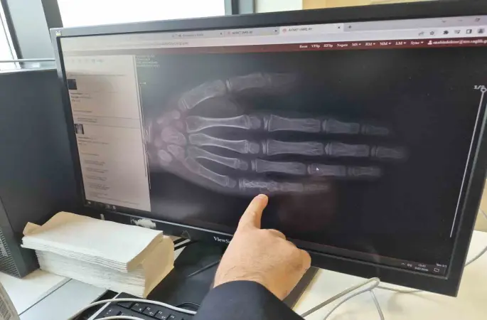 Eskişehir’de her ay 5 ila 7 çocuğa kanser tanısı konuluyor
