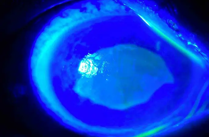 ’Kırlangıç otu kullanımı’na dikkat, uzmanlar uyarıyor: 